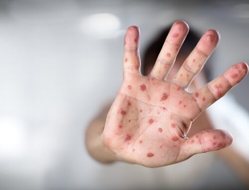 Homeopathy for Hand, Foot and Mouth Disease